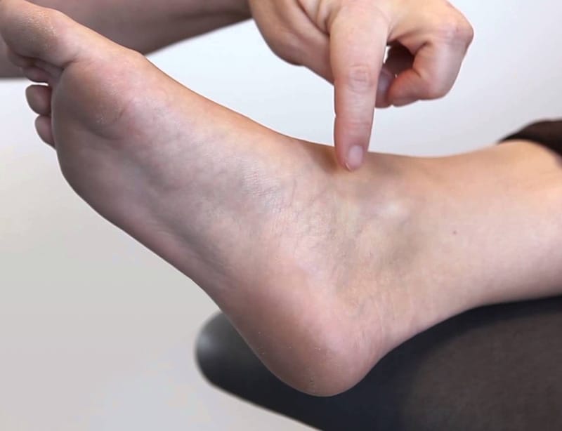 La tendinopathie du muscle tibial postérieur